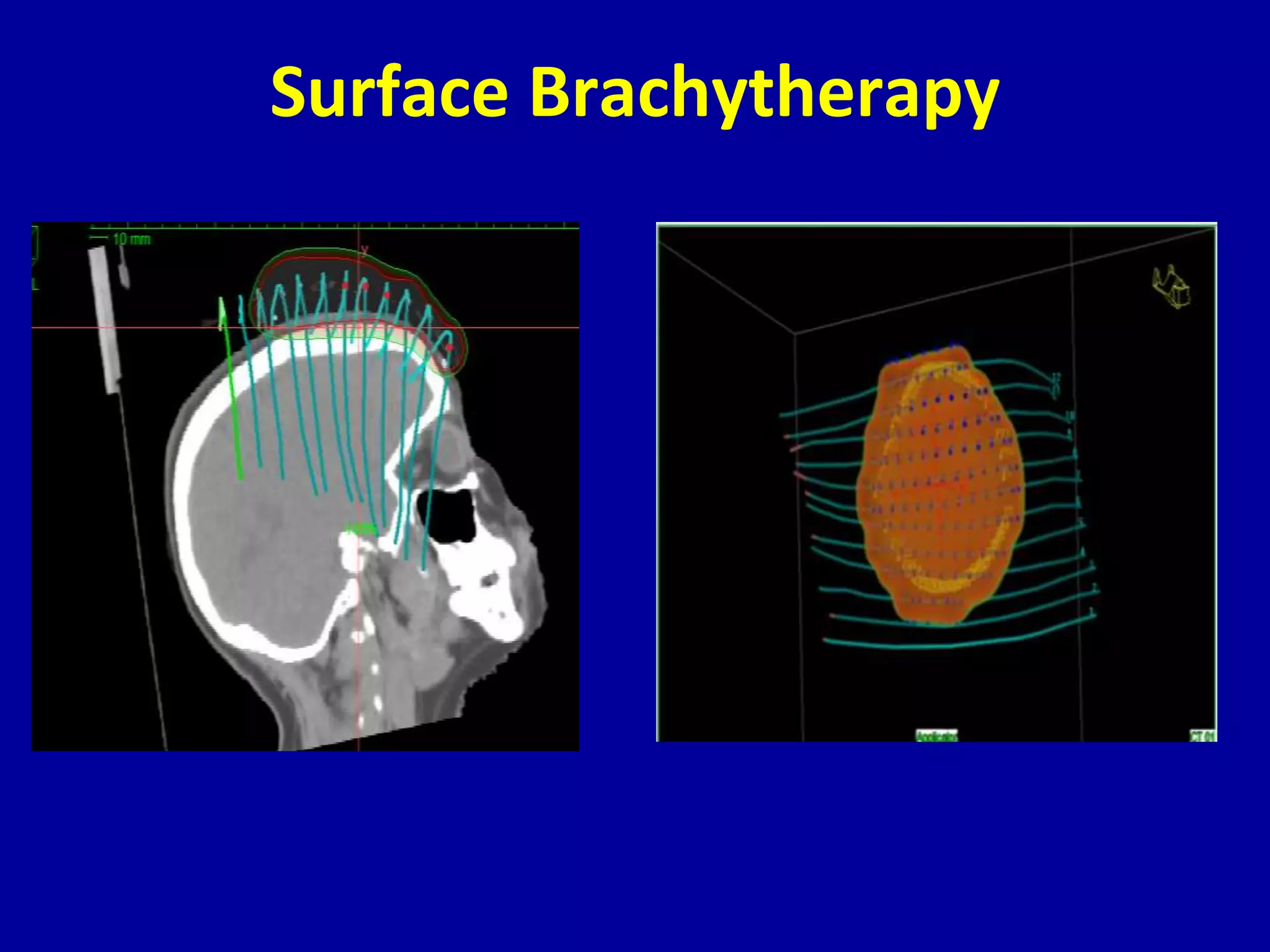 Surface Brachytherapy
 
