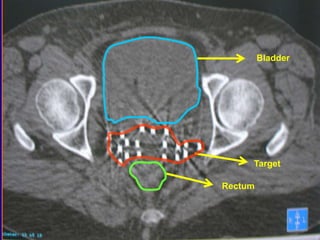 brachytherapy | PPTX