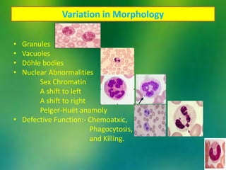 Variation in Morphology
• Granules
• Vacuoles
• Dӧhle bodies
• Nuclear Abnormalities
Sex Chromatin
A shift to left
A shift to right
Pelger-Huёt anamoly
• Defective Function:- Chemoatxic,
Phagocytosis,
and Killing.
 