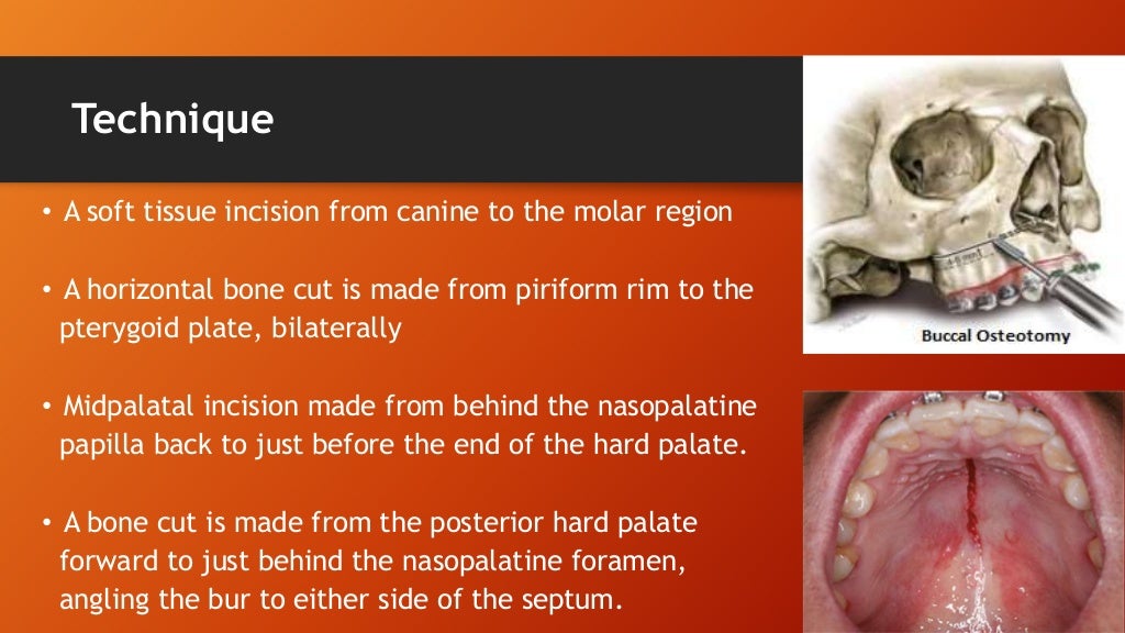 Orthognathic Surgical Procedure on nongrowing patients with maxillar…