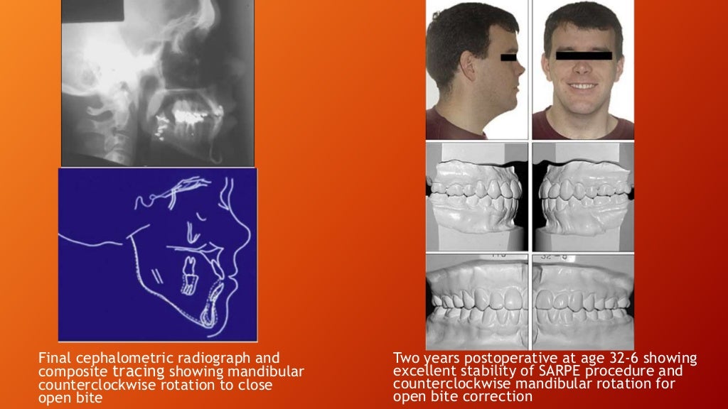 Orthognathic Surgical Procedure on nongrowing patients with maxillar…