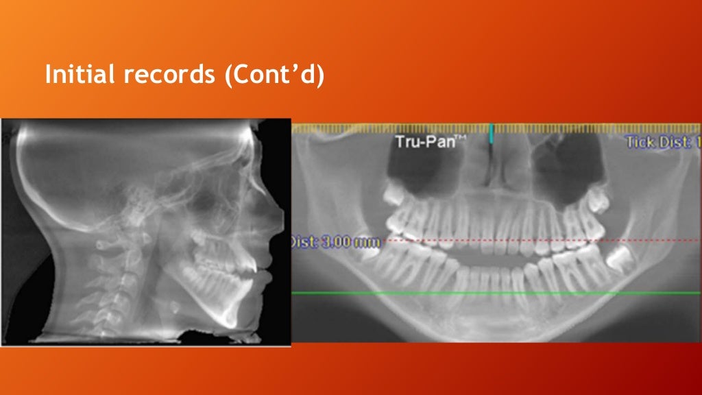 Orthognathic Surgical Procedure on nongrowing patients with maxillar…