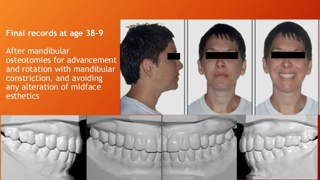 Orthognathic Surgical Procedure on nongrowing patients with maxillar…