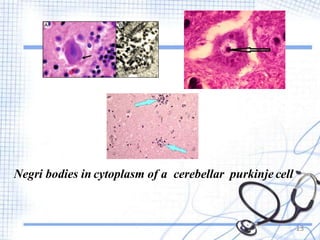 Negri bodies in cytoplasm of a cerebellar purkinje cell
13
 