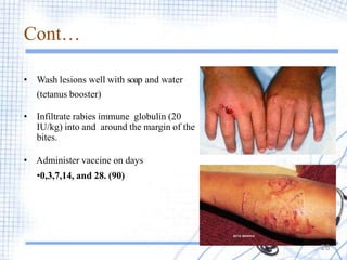 Cont…
• Wash lesions well with soap and water
(tetanus booster)
• Infiltrate rabies immune globulin (20
IU/kg) into and around the margin of the
bites.
• Administer vaccine on days
•0,3,7,14, and 28. (90)
26
 