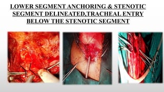 LOWER SEGMENT ANCHORING & STENOTIC
SEGMENT DELINEATED,TRACHEAL ENTRY
BELOW THE STENOTIC SEGMENT
 