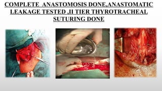 COMPLETE ANASTOMOSIS DONE,ANASTOMATIC
LEAKAGE TESTED ,II TIER THYROTRACHEAL
SUTURING DONE
 