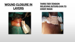 WOUND CLOSURE IN
LAYERS
THIRD TIER TENSION
RELIEVING SUTURE-CHIN TO
CHEST MADE
 