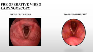 PRE OPERATIVE VIDEO
LARYNGOSCOPY
COMPLETE OBSTRUCTION
PARTIAL OBSTRUCTION
 