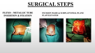 FLEXO – METALLIC TUBE
INSERTION & FIXATION
SURGICAL STEPS
INCISION MADE & SUBPLATYSMAL PLANE
FLAP ELEVATED
 