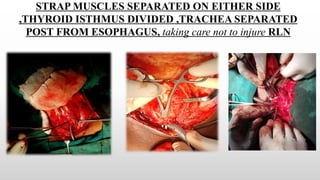 STRAP MUSCLES SEPARATED ON EITHER SIDE
,THYROID ISTHMUS DIVIDED ,TRACHEA SEPARATED
POST FROM ESOPHAGUS, taking care not to injure RLN
 