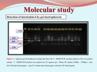 Molecular study
Figure 5 :- Agarose gel electrophoresis image that show the T . ARMS-PCR product analysis of IL-6 in patient
sample . T . ARMS-PCR product was analysis by 2% agarose gel . Where M: marker (100bp – 1500bp ) , lane
GG wild type homozygote , lane CC mutant type homozygote, and lane GC heterozygote
Detection of interleukin-6 by gel electrophoresis
 