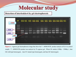 Molecular study
Figure 6 :- Agarose gel electrophoresis image that show the T . ARMS-PCR product analysis of IL-6 in control
sample . T . ARMS-PCR product was analysis by 2% agarose gel . Where M: marker (100bp – 1500bp ) , lane
GG wild type homozygote , lane CC mutant type homozygote, and lane GC heterozygote
Detection of interleukin-6 by gel electrophoresis
 