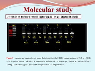 Molecular study
Figure 5 :- Agarose gel electrophoresis image that shows the ARMS-PCR product analysis of TNF–α (-308 G
→A) in patient sample . ARMS-PCR product was analyzed by 2% agarose gel . Where M: marker (100bp –
1500bp ) . GA heterozygous , positive PCR amplification 184 bp product size.
Detection of Tumor necrosis factor alpha by gel electrophoresis
 