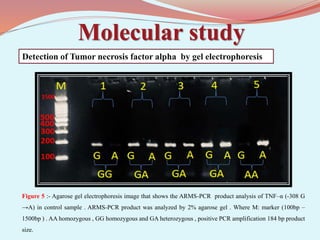 Molecular study
Figure 5 :- Agarose gel electrophoresis image that shows the ARMS-PCR product analysis of TNF–α (-308 G
→A) in control sample . ARMS-PCR product was analyzed by 2% agarose gel . Where M: marker (100bp –
1500bp ) . AA homozygous , GG homozygous and GA heterozygous , positive PCR amplification 184 bp product
size.
Detection of Tumor necrosis factor alpha by gel electrophoresis
 