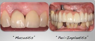 The peri-implant diseases are characterized by an infection