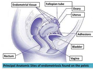 Endometrial tissue Fallopian tube
Ovary
Uterus
Adhesions
Bladder
Vagina
Rectum
Principal Anatomic Sites of endometriosis found on the pelvic
 