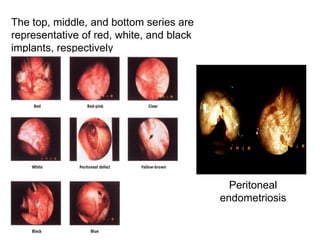 The top, middle, and bottom series are
representative of red, white, and black
implants, respectively
Peritoneal
endometriosis
 