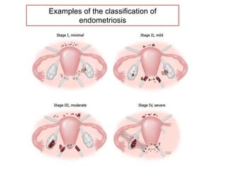 Examples of the classification of
endometriosis
 