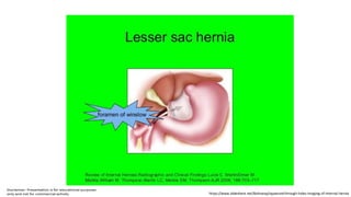 https://www.slideshare.net/Bahnassy/squeezed-through-holes-imaging-of-internal-hernia
 
