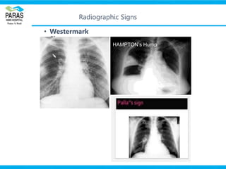 Watermark Sign Radiology pulmonary embolism | PPTX
