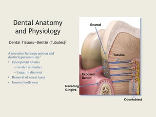 Association between erosion and
dentin hypersensitivity3
• Open/patent tubules
– Greater in number
– Larger in diameter
• Removal of smear layer
• Erosion/tooth wear
Enamel
Exposed
Dentin
Receding
Gingiva
Tubules
Odontoblast
Dental Anatomy
and Physiology
Dental Tissues—Dentin (Tubules)2
 
