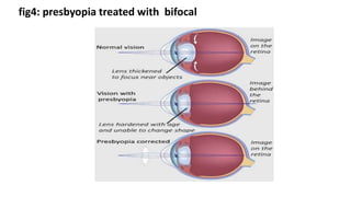 fig4: presbyopia treated with bifocal
 