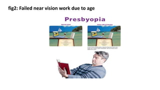 fig2: Failed near vision work due to age
 