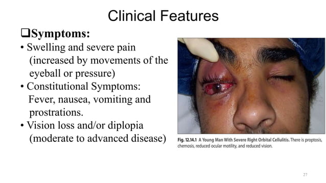 Preseptal Cellulitis & Orbital Cellulitis -Dr. Prabhat Devkota.pptx ...