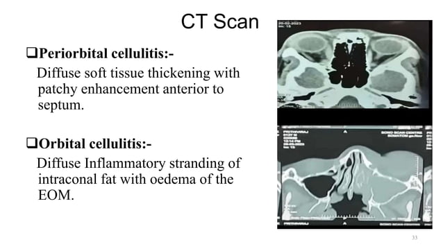 Preseptal Cellulitis & Orbital Cellulitis -Dr. Prabhat Devkota.pptx ...