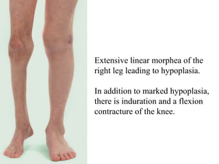 Linear Induration Dr.Tarik Enaairi - Morphea and Lichen Sclerosus.ppsx