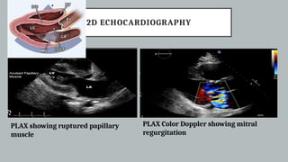 Plax Rvit With Color MANAGEMENT OF ACUTE TRAUMA IN ER - CARDIOLOGIST PERSPECTIVE.pptx