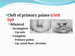 Dr. Saad Gasgus cleft lip and palate-1 (Muhadharaty).ppt