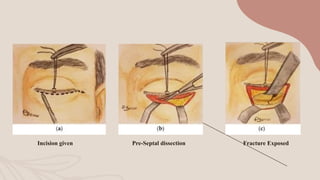 Zygomatic Orbital Fracture : The Lower Blephroplasty Incision as a ...
