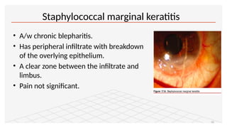 Marginal Infiltrates Peripheral Ulcerative Keratitis & Mooren’s Ulcer- Dr. Prabhat Devkota.pptx