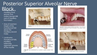 Posterior Superior Alveolar Nerve
Block
• Effective for the
maxillary third,
second, first
molars (except MB
root of maxillary
first molar)
• Area of insertion:
Height of the
mucobuccal fold
above the
maxillary second
molar.
• Landmarks:
mucobuccal fold,
maxillary
tuberosity,
zygomatic process
of the maxilla
 