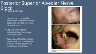 Posterior Superior Alveolar Nerve
Block
Complications
• Hematoma: produced by
insertion of the needle too far
posteriorly into the pterygoid
plexus of veins.
• Use of a short needle
minimizes risk of pterygoid
plexus puncture
• Deposition of local anesthetic
lateral to desired location can
produce varying degrees of
mandibular anesthesia
 