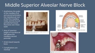 Middle Superior Alveolar Nerve Block
• Anethetizes the pulps
of the maxillary first
and second premolars,
the mesiobuccal root
of the first maxillary
molar, and the buccal
periodontal tissues
that bone over these
teeth
• Area of insertion:
height of mucobuccal
fold above the
maxillary second
premolar
• Orient bevel towards
bone
• Complications are
minimal
 