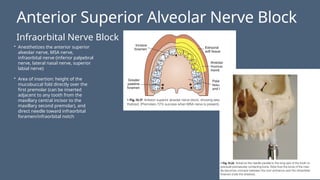 Anterior Superior Alveolar Nerve Block
Infraorbital Nerve Block
• Anesthetizes the anterior superior
alveolar nerve, MSA nerve,
infraorbital nerve (inferior palpebral
nerve, lateral nasal nerve, superior
labial nerve)
• Area of insertion: height of the
mucobuccal fold directly over the
first premolar (can be inserted
adjacent to any tooth from the
maxillary central incisor to the
maxillary second premolar), and
direct needle toward infraorbital
foramen/infraorbital notch
 