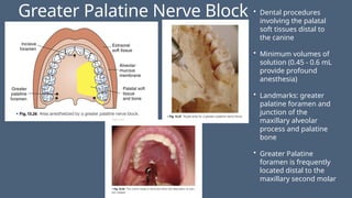 Greater Palatine Nerve Block • Dental procedures
involving the palatal
soft tissues distal to
the canine
• Minimum volumes of
solution (0.45 - 0.6 mL
provide profound
anesthesia)
• Landmarks: greater
palatine foramen and
junction of the
maxillary alveolar
process and palatine
bone
• Greater Palatine
foramen is frequently
located distal to the
maxillary second molar
 