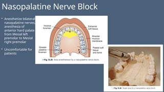 Nasopalatine Nerve Block
• Anesthetize bilateral
nasopalatine nerves,
anesthesia of
anterior hard palate
from Mesial left
premolar to Mesial
right premolar
• Uncomfortable for
patients
 