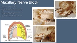 Maxillary Nerve Block
• Maxillary Division of Trigeminal Nerve
• Pulpal Anesthesia of the maxillary teeth ipsilateral to
block, buccal periodontium and bone overlying the
teeth
• Soft tissues and bone of the hard palate and part of
the soft palate, medial to midline
• Skin of the lower eyelid, side of nose, cheek, upper
lip
 