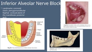 Inferior Alveolar Nerve Block
• Landmarks: coronoid
notch, pterygomandibular
Raphae occlusal plane of
the mandibular posterior
arch
 