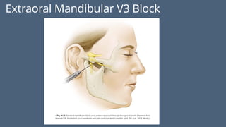 Extraoral Mandibular V3 Block
 
