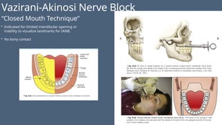 Vazirani-Akinosi Nerve Block
“Closed Mouth Technique”
• Indicated for limited mandibular opening or
inability to visualize landmarks for IANB.
• No bony contact
 