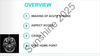 The Role of Neuroimaging in Acute Stroke | PDF