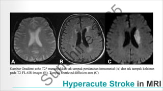 The Role of Neuroimaging in Acute Stroke | PDF