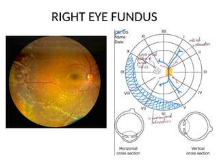 X linked Retinoschisis Fundus presentation | PPTX