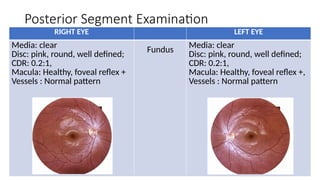 Ocular Surface Squamous Neoplasia (OSSN) Case presentation- Dr. Prabhat ...
