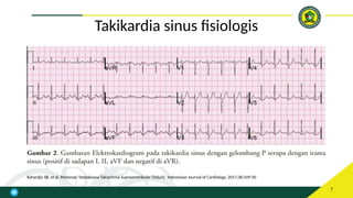referat supraventrikular takikardia atau svt | PPTX